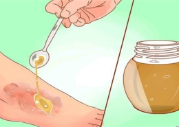 درمان زخم ناشی از جراحی با عسل طبیعی